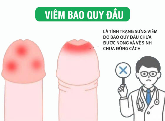 Dấu hiệu viêm bao quy đầu cần chữa ngay