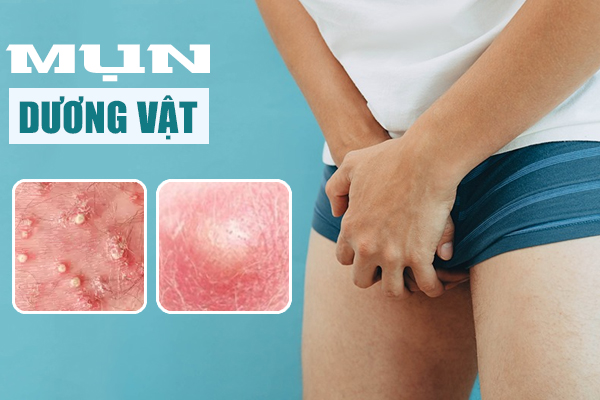 NỔI MỤN DƯƠNG VẬT LÀ BỊ BỆNH GÌ? ĐỊA CHỈ KHÁM CHỮA UY TÍN