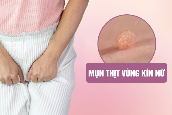 MỌC MỤN THỊT VÙNG KÍN NỮ - TRIỆU CHỨNG KHÔNG NÊN CHỦ QUAN