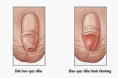 Nguyên Nhân Dài Bao Quy Đầu Là Gì? Phương Pháp Nào Điều Trị Hiệu Quả