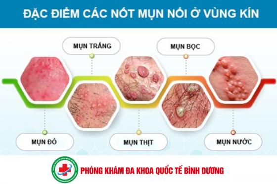 Dấu hiệu nổi mụn bất thường ở vùng kín chớ nên chủ quan