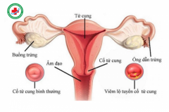 Viêm cổ tử cung  Nguyên nhân, triệu chứng, chẩn đoán và điều trị