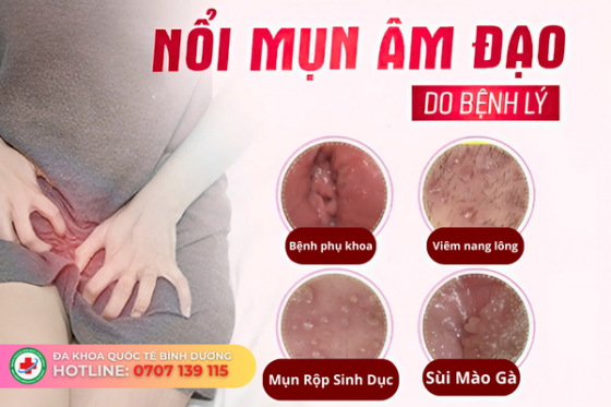 Nổi Mụn Âm Đạo Là Triệu Chứng Bệnh Gì? Tìm Hiểu Ngay