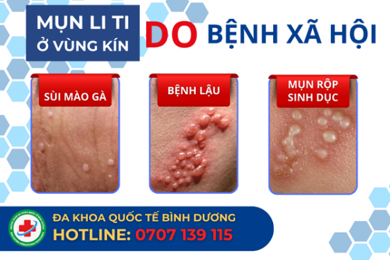 Nổi Mụn Li Ti Ở Vùng Kín Nam