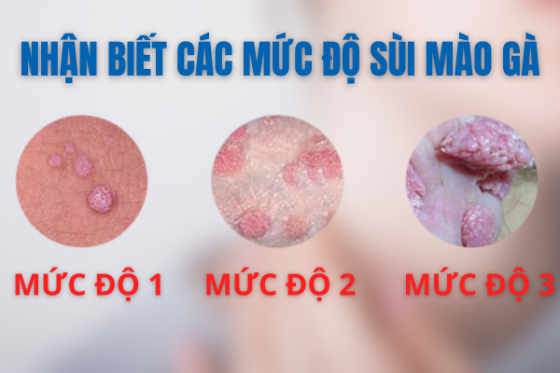 NGUYÊN NHÂN GÂY NÊN BỆNH SÙI MÀO GÀ