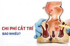 CHI PHÍ CẮT TRĨ BAO NHIÊU? PHÒNG KHÁM CẮT TRĨ MINH BẠCH VỀ GIÁ