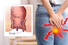 Biểu Hiện Của Bệnh Trĩ Như Thế Nào ?