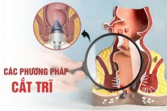 Các Phương Pháp Cắt Trĩ An Toàn Hiệu Quả Hiện Nay