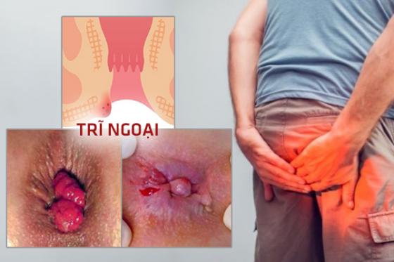 hinh-anh-benh-tri-1.jpg